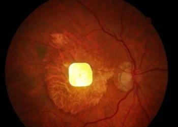 Wireless implant offering hope for people with macular degeneration